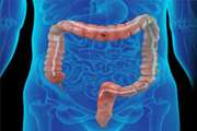 What is your diagnosis? Diagnosis: Post Colonoscopic Bowel Perforation in Underlying Secondary Amyloidosis